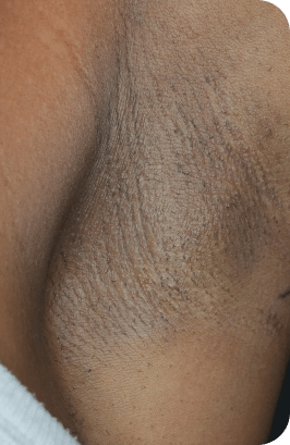 Laser hair removal underarms before treatment